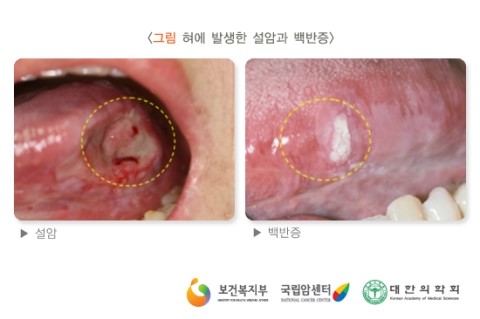 설암,설암 초기증상 : 네이버 블로그