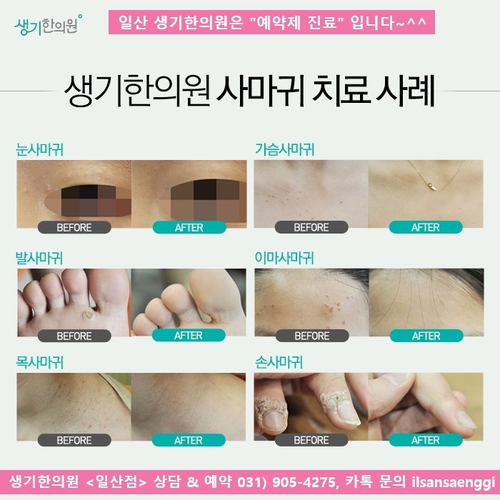 파주 사마귀 구별하는 방법 : 네이버 포스트