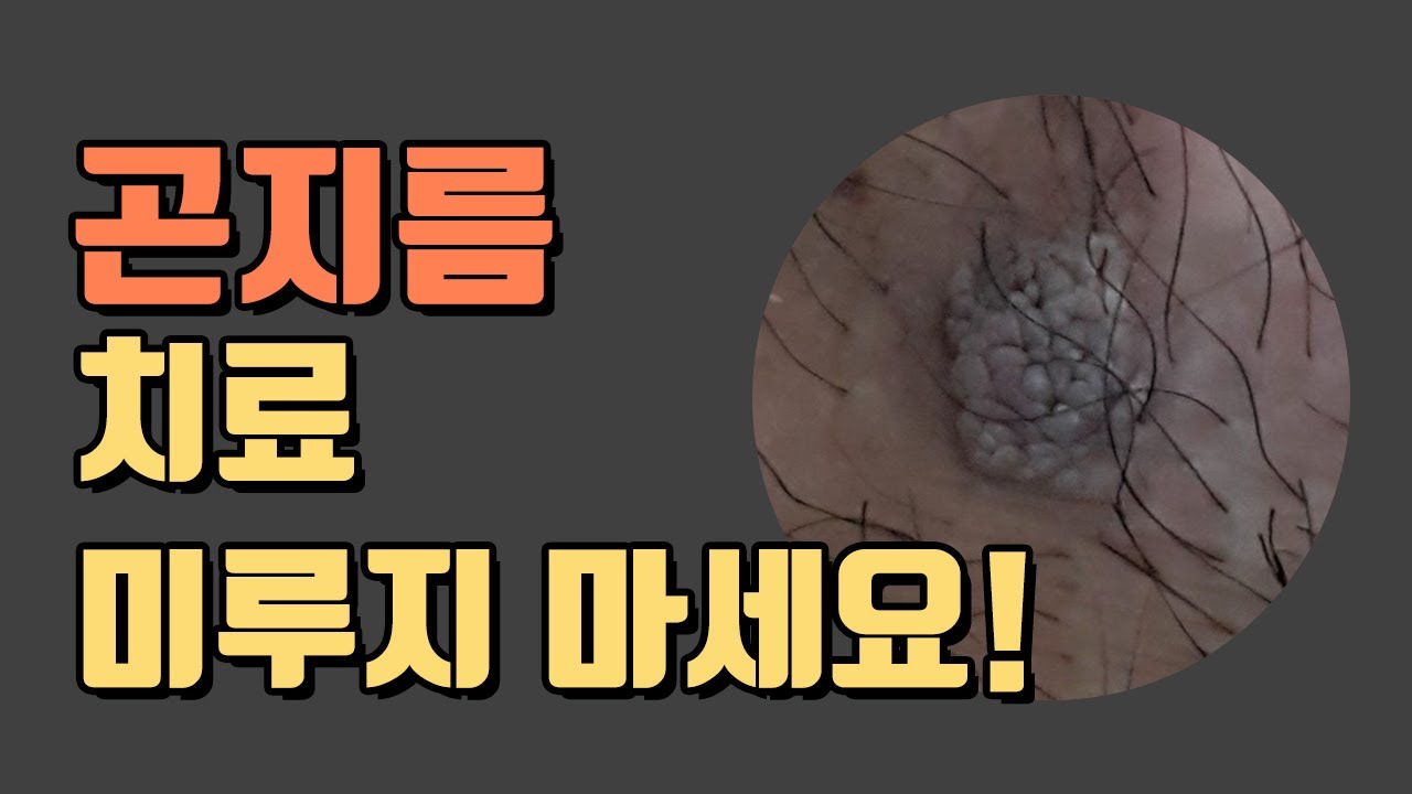 곤지름(Condyloma 콘딜로마) = 성기사마귀 치료 미루지 마세요! - Youtube