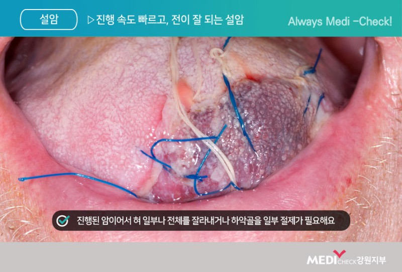 설암 초기증상과 구내염과 구별법! : 네이버 블로그