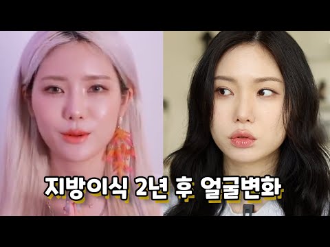 GRWM 지방이식 2년 뒤 후기 리뷰 (시술 토크👀) + 메리쏘드 컨실러 지속력까지 /꽁지 KKONGJI