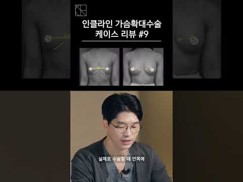 벌어진가슴골, #가슴성형후기