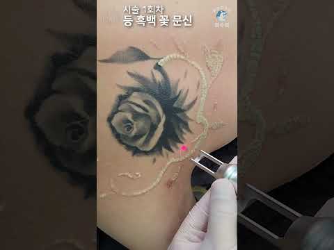 등 꽃 문신(타투)제거 ASMR - ALL 수면마취 [Laser Tattoo Removal]